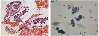 Endometrial Cytology as a Method to Improve the Accuracy of Diagnosis of Endometrial Cancer: Case Report and Meta-Analysis